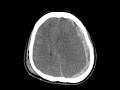 Case 3_ Subdural hemorrhage (SDH)