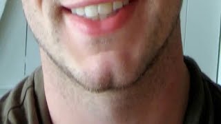 how to get rid of a cleft chin fast and easy