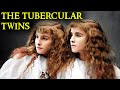 The Tragic Case of the Tubercular Twins