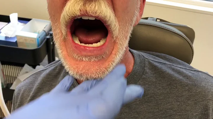 Lower Suction Dentures— Amazing Fit!