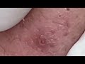 Выдавливание угрей. чистка лиц.ЗАЛИПАЮЩЕЕ ВИДЕО