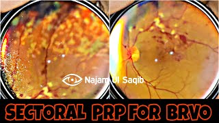Sectoral PanRetinal Photocoagulation(PRP) For Branch Retinal Vein Occlusion