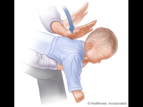 Prva pomoć kod gušenja bebe (First aid for choking baby)