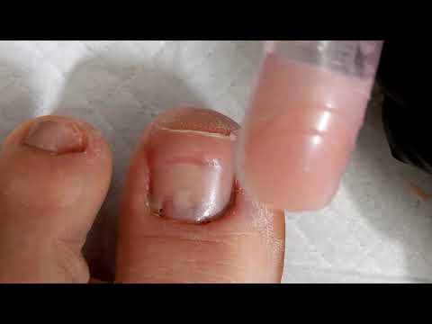 Natural FAKE ACRYLIC Toenails Using Dual Forms  / On Toes Missing Toenails Part 2