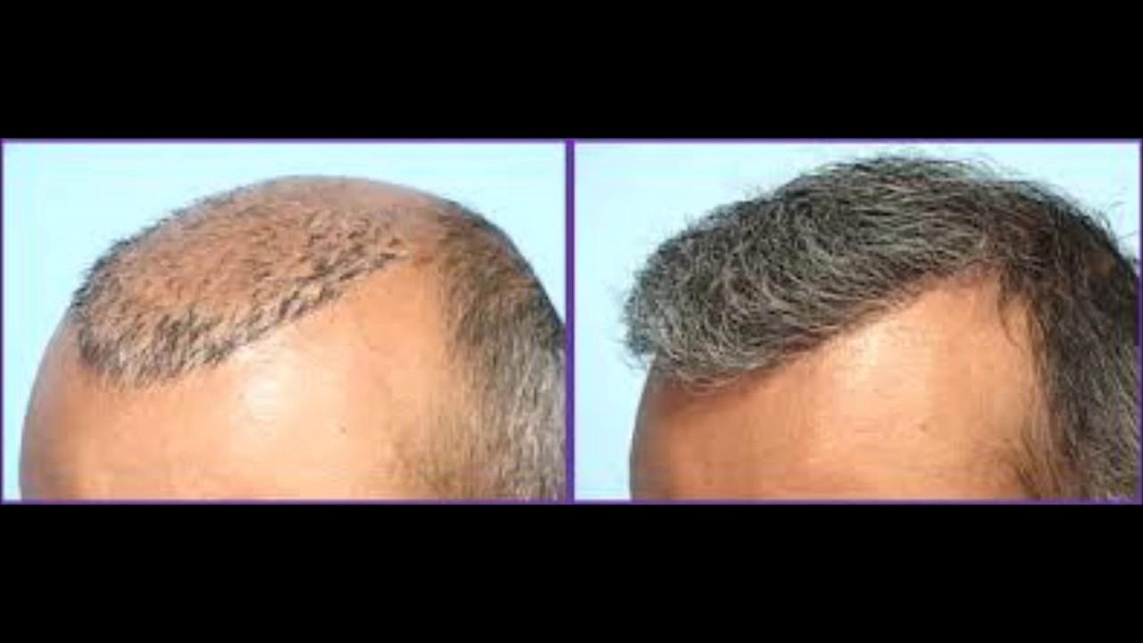 Can We Regrow Lost Hair How To Use Emu Oil For Hair Loss YouTube