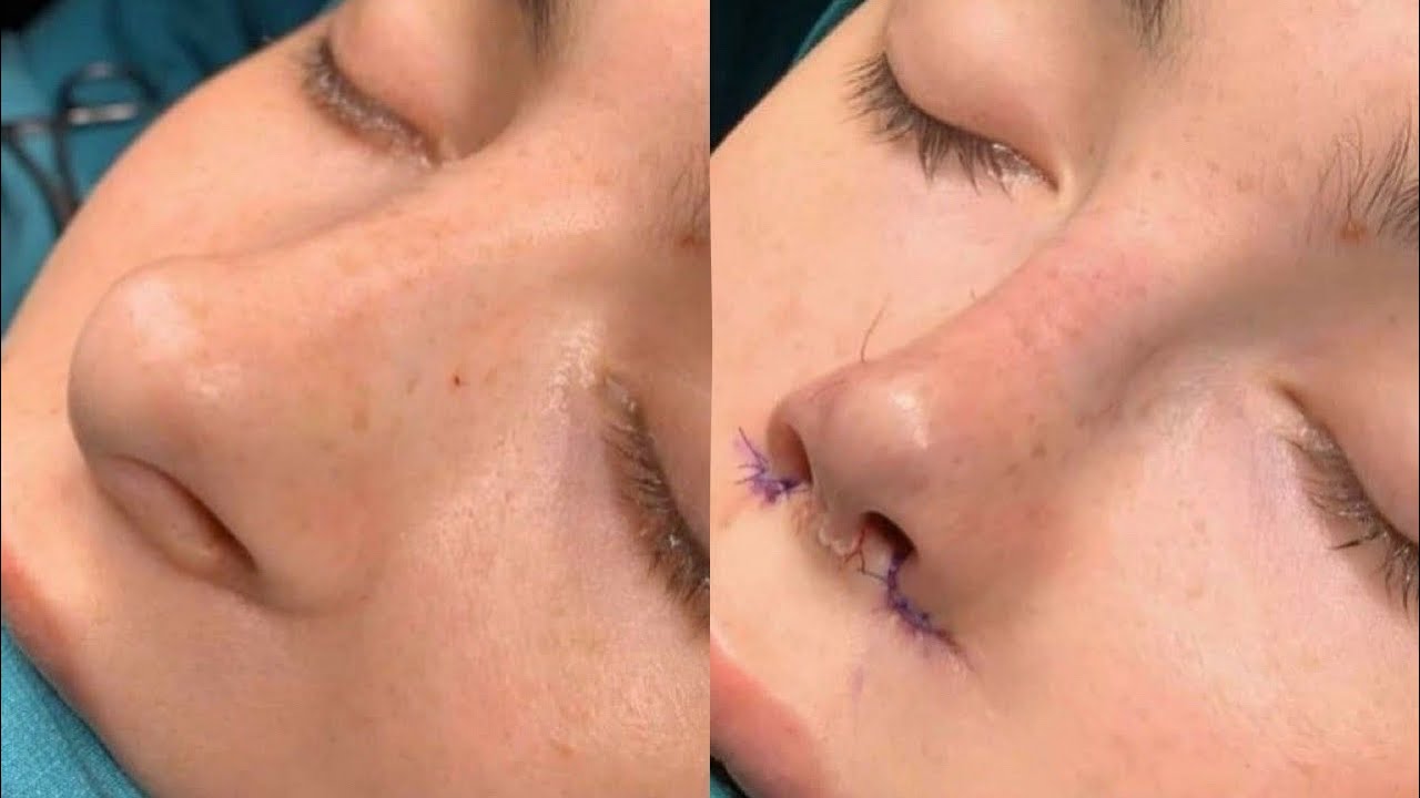 💉bulbous nose tip reduction ୨୧ thin nose tip & defined nasal bridge — exp ⚠️