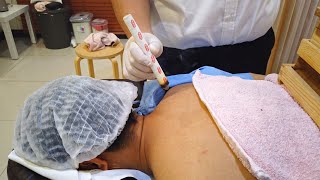 Unreal Chinese Medical Therapy That Relieve Back Shoulder Pains Moxibustion