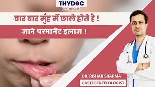 मुँह के छाले ठीक करने के घरेलु उपाय, Mouth Ulcer Ka ilaaj, Mouth Ulcer Kyu Hota Hai,Dr.Rishab Sharma