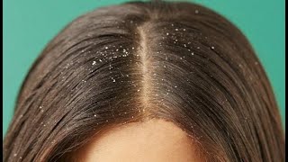 وصفة مجربة لعلاج قشرة الشعر