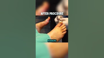 How Do You Get Rid Of Corns On Your Foot Permanently