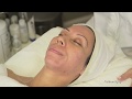 Skin Prepped & Deep Scarring Peel