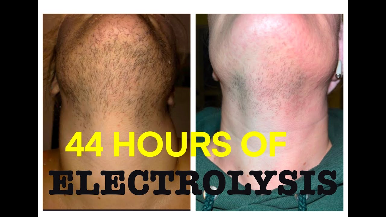 44 Hours Of Electrolysis Satisfying Permanent Facial Hair Removal