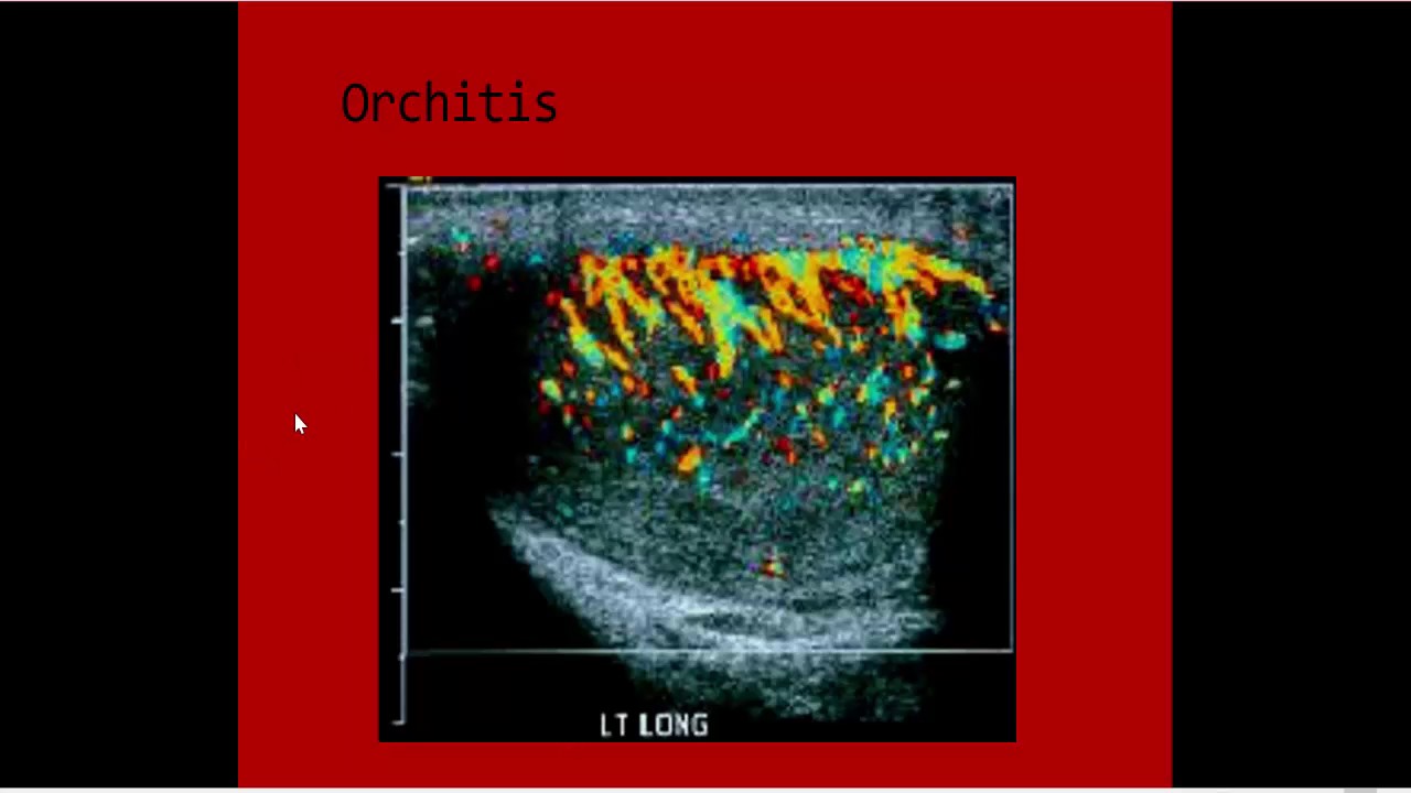 Orchitis Ct full story orchitis,epidydmitis,epidydmo orchitis imaging Dr Ahmed ...
