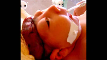 O que é anencefalia em bebê?