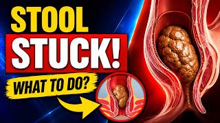 Stool STUCK in the Rectum The Hidden Warning Signs Doctors Want You to Know
