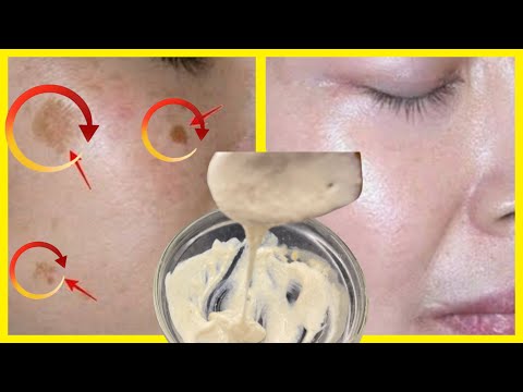 1 ہفتے کے لیے ہر رات لگائیں، چہرے کے دھبے ختم کریں! DIY جلد کے راز! خوبصورتی کے راز (100% قدرتی)