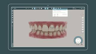 Elastics Feature in Orthodontic Treatment Planning Software screenshot 1