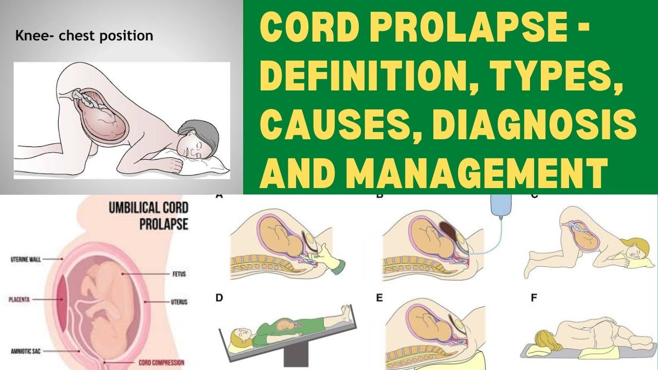 What is Cord prolapse ? Definition, Types, Etiology, Diagnosis and
