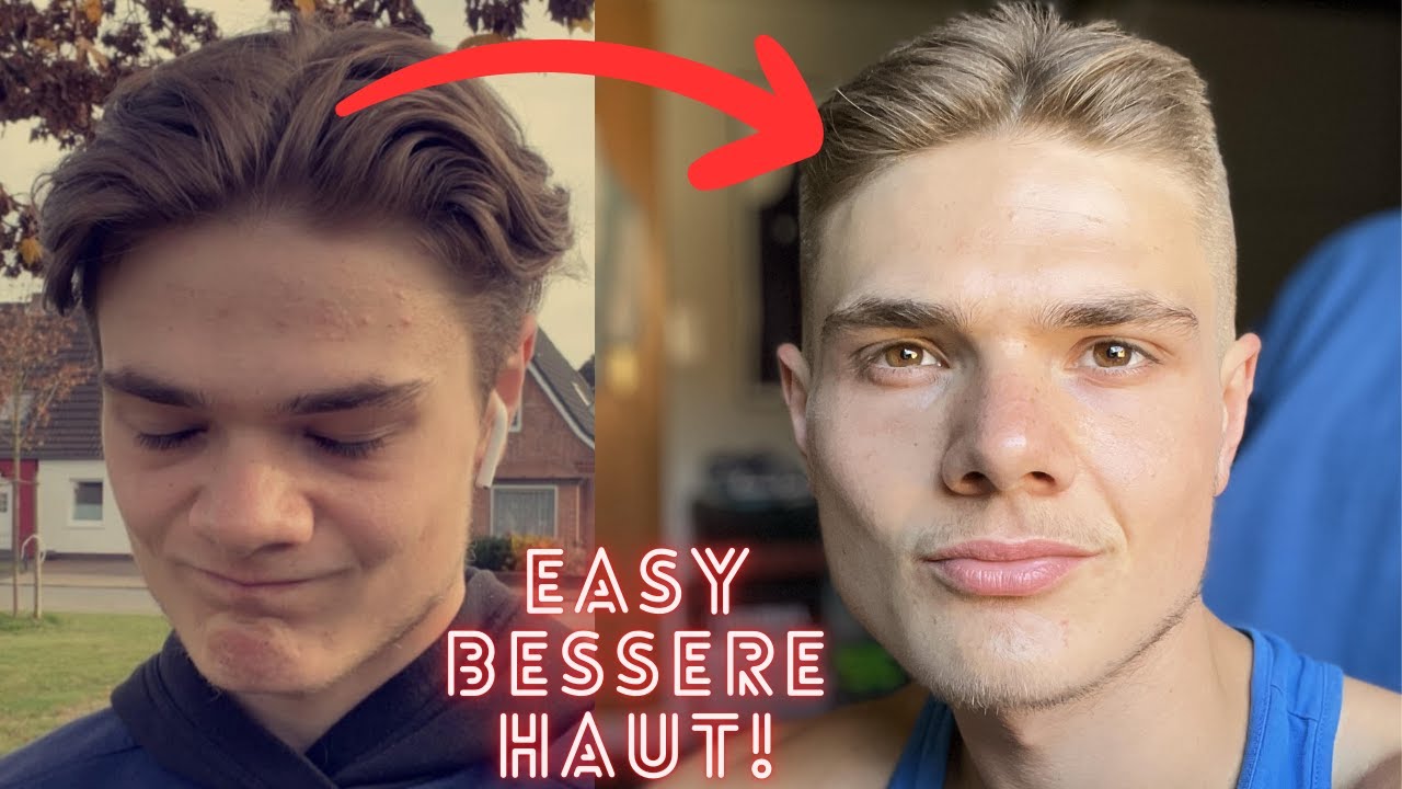 Wie ich endlich reine Haut bekommen habe! (2 einfache Schritte) YouTube