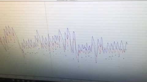 Minnesota Concussion Recovery- VNG OPK reflex testing