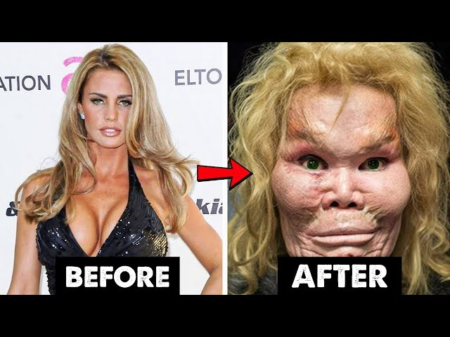 Celebrity Before And After Plastic Surgery Disasters