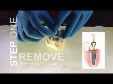 How to make impressions for dental implants