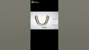 Smilesalign - Niềng khay trong suốt số 1 Việt Nam