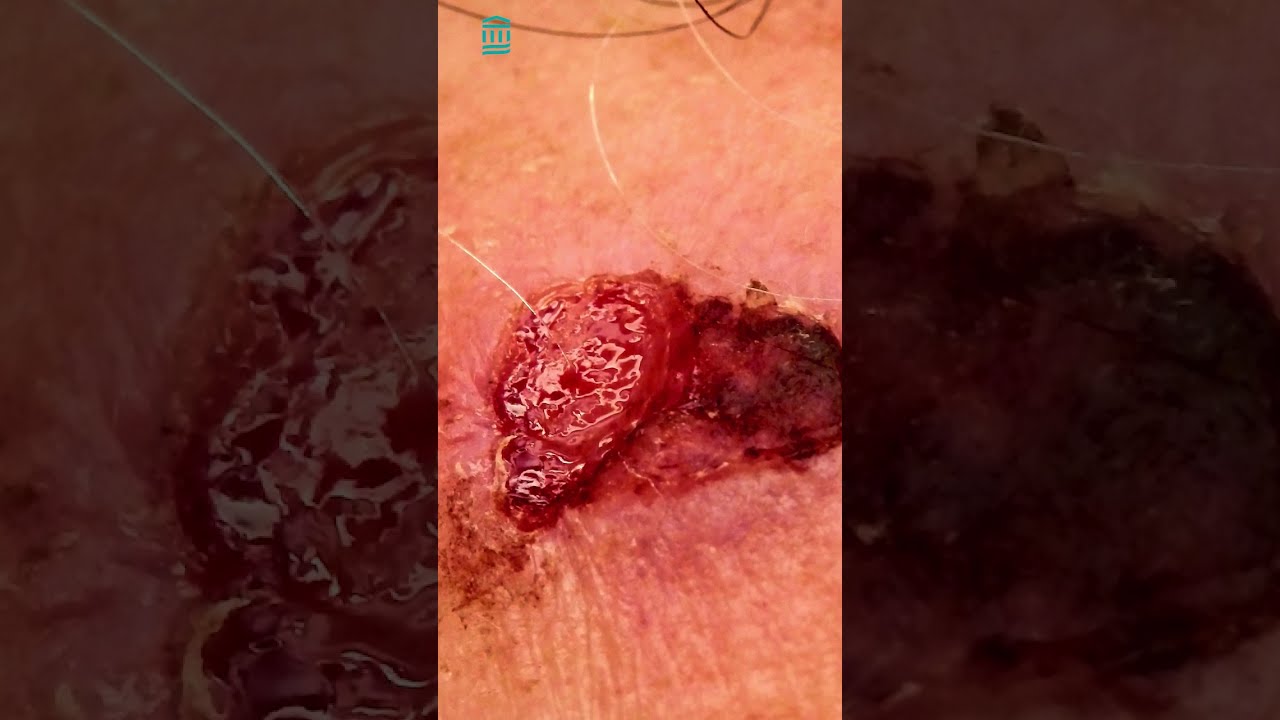 What Is Squamous Cell Carcinoma Shorts