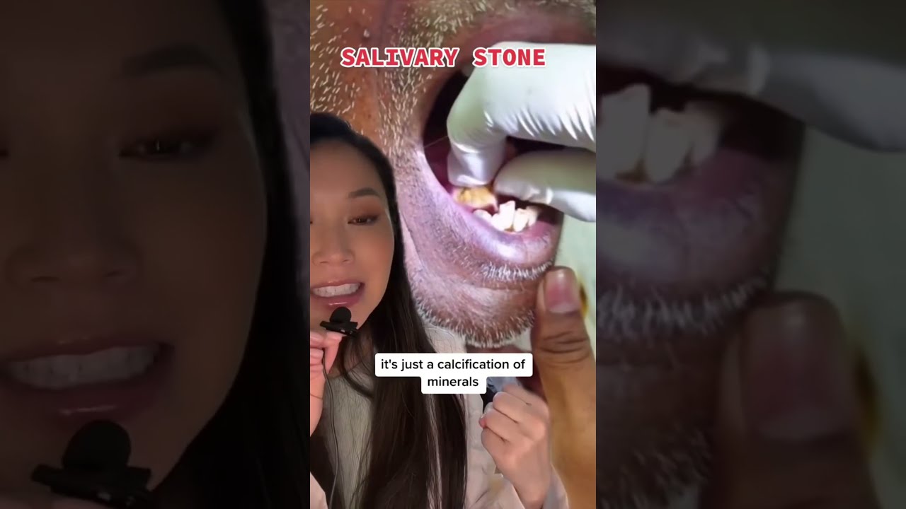 Biggest Salivary Stone I Ve Ever Seen Salivarystone Tonsilstone Mouthstone Mouthsore Dentist