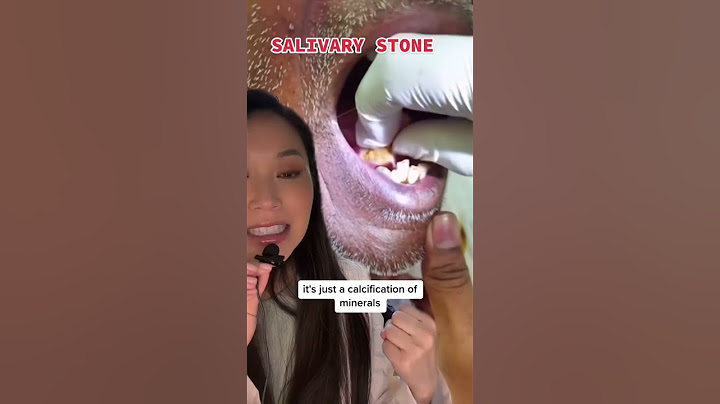 Biggest salivary stone I’ve ever seen! #salivarystone #tonsilstone #mouthstone #mouthsore #dentist