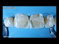 Aesthetic Composite Restorations - Upper Centrals