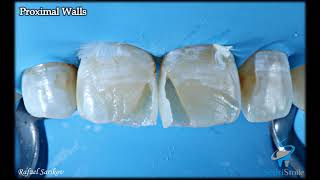 Aesthetic Composite Restorations - Upper Centrals