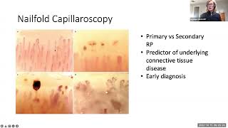 New Treatments for Patients living with Scleroderma, Monique Hinchcliff, MD, MS