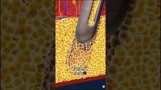 Say Goodbye To Armpit Bulge Axillary Breast Tissue Removal Explained By Dr. Varsha Bundele