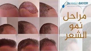 مراحل نمو الشعر المزروع - دكتور يتكين باير  | Dr. Bayer Clinics
