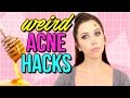 How to Get Rid of Acne FAST - WEIRD ACNE LIFE HACKS | Courtney Lundquist