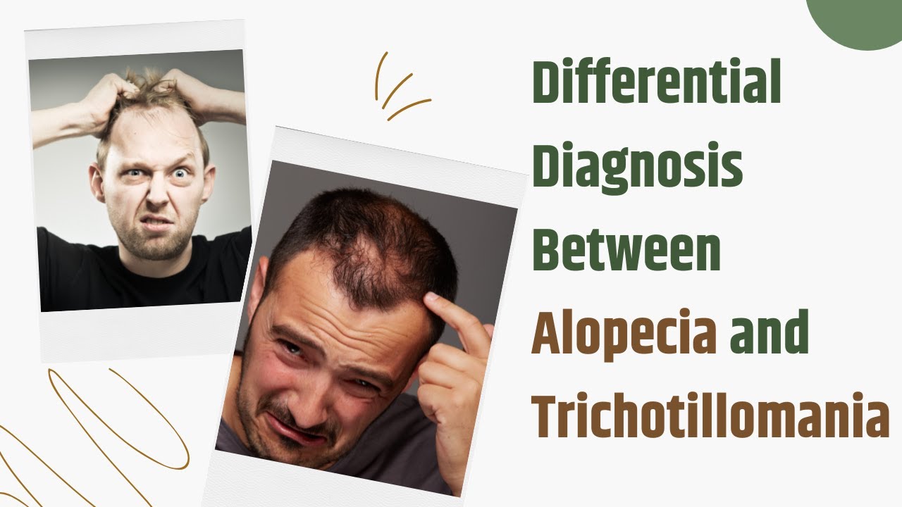 Differential Diagnosis Between Alopecia Areata and Trichotillomania