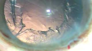 Vertical chop in soft cataract by Pradip Mohanta, M.S.(PGI, Chandigarh) screenshot 4