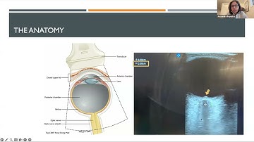 Neurocritical Care & Pearls: Noninvasive Monitoring of Intracranial Pressure, Alexandra Reynolds, MD
