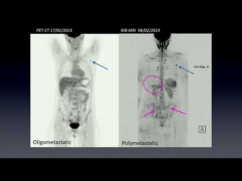 Imaging of bone metastasis - Guiseppe Petralia