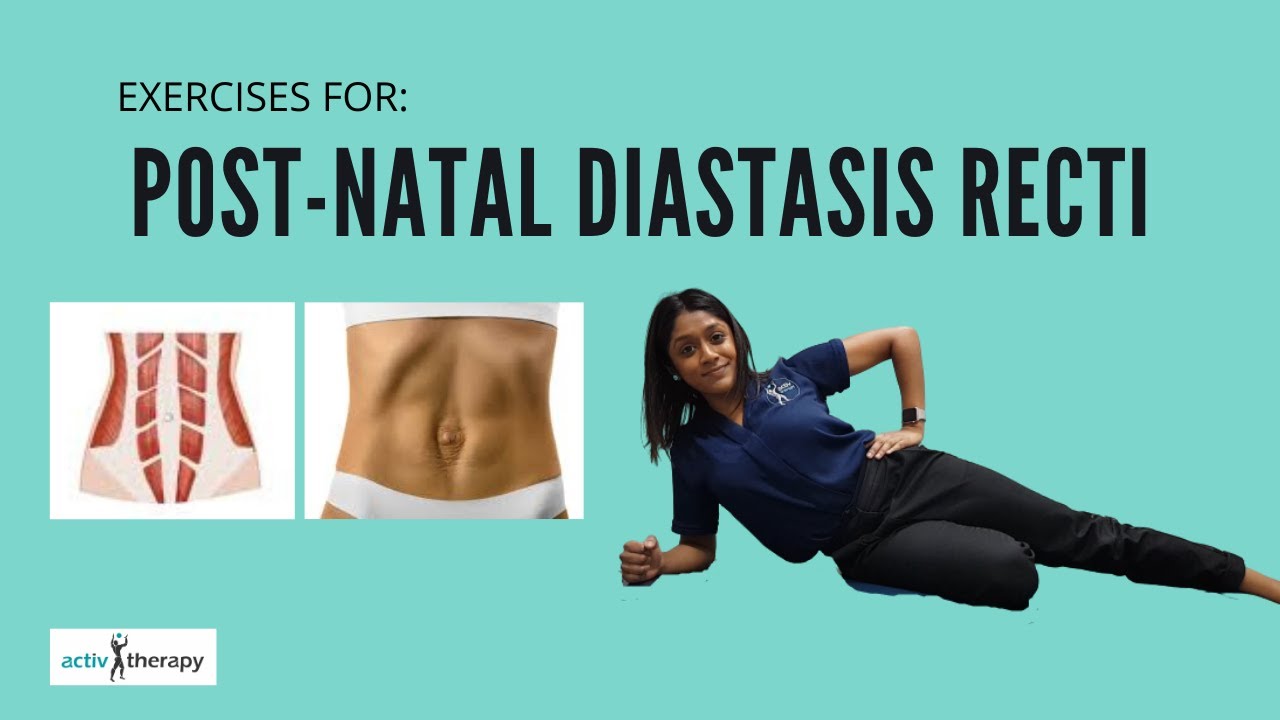 Exercises for diastasis recti (abdominal separation) 