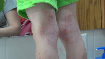 Mayo Clinic Minute  - Atopic dermatitis triggers