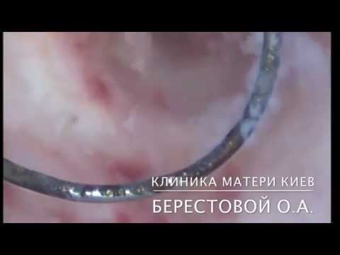 Гистерокопия, синдром Ашермана,  однорогая матка зв