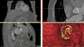 Case #42 : Paravalvular leak