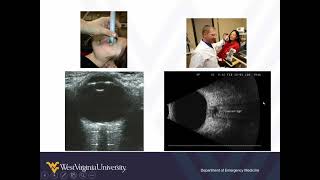 Ocular Point-of-Care Ultrasound 1 - Normal Anatomy and Findings