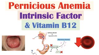 Pernicious Anemia (Rare Cause of Vitamin B12 Deficiency) | Causes, Symptoms, Diagnosis, Treatment