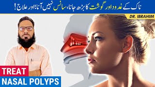 Naak Mein Gosht/Gadood Ka Barh Jana - Nasal Polyps Causes & Treatment - Urdu/Hindi - Dr. Ibrahim screenshot 4