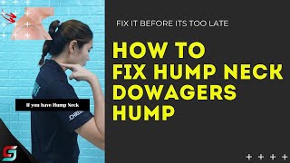 How to FIX Hump Neck - 1 Simple Exercise