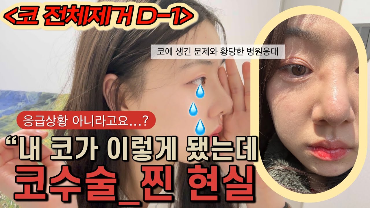 [코수술 현실vlog] Ep.1 성형부작용으로 멘탈이 폭삭 무너졌쑤다💦 내가 겪은 보형물 이상증세와 황당한 병원 응대 찐 후기…🤯