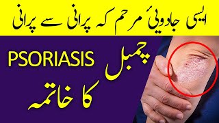 CHAMBAL Ka Ilaj | چمبل | Psoriasis | Signs & Treatment in URDU/HINDI | Hakeem Malik Ahmad Farooq